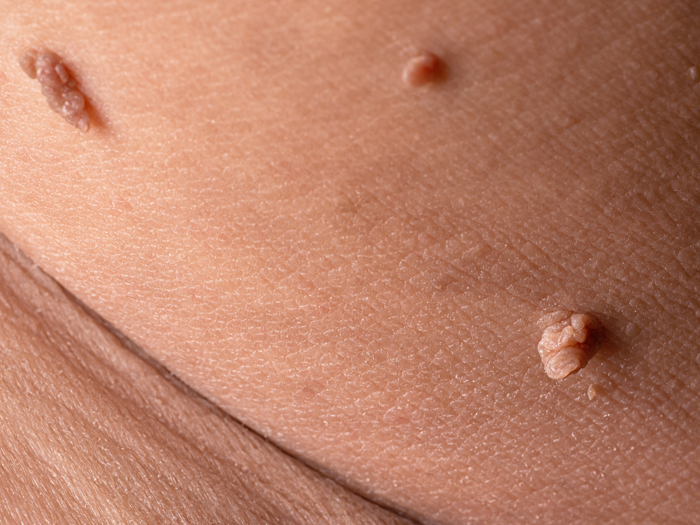 Differenza fra emorroidi e fibroma pendulo
